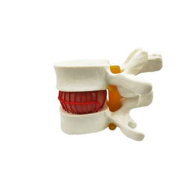 Анатомическая модель грыжи поясничного диска человека Corpo de Hernia-2