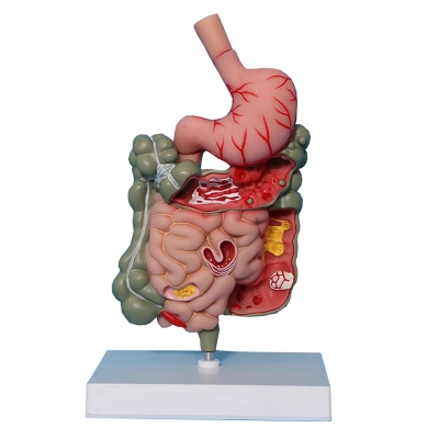 Патологическая модель толстой кишки желудочно-кишечного тракта Corpo GIT-5